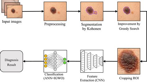 The steps of the proposed method for skin cancer diagnosis. | Download Scientific Diagram