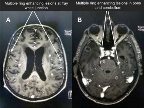 Brain MRI. Notes: (A) Brain MRI showing multiple ring enhancing lesions... | Download Scientific ...