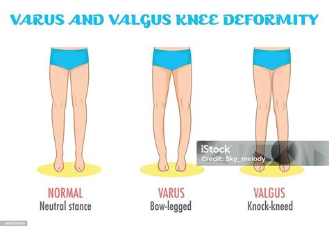 Vetores De Joelho Valgo Varo Doença Das Pernas Infográfico De