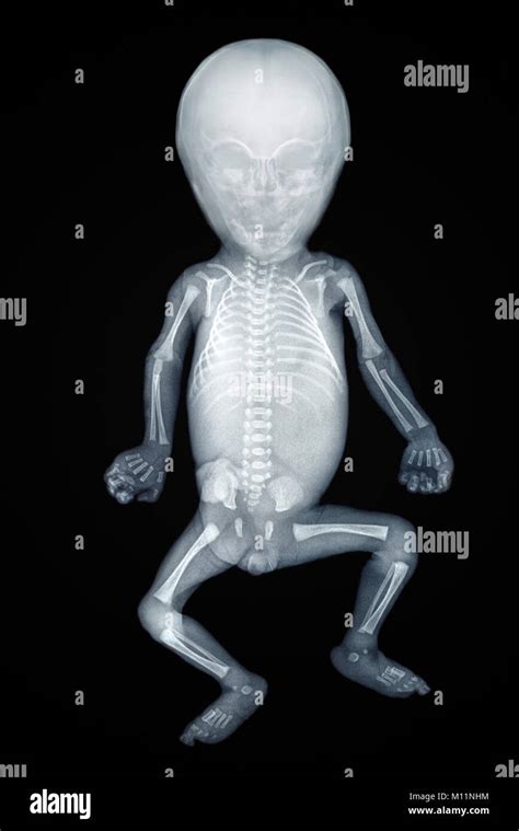 X Ray Of A Baby Front View Stock Photo Alamy