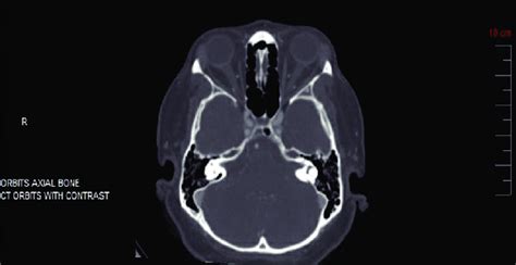 CT scan of orbits with contrast was unremarkable without orbital tissue... | Download Scientific ...