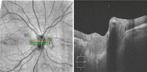 Retinal Artery Occlusion | Ento Key 