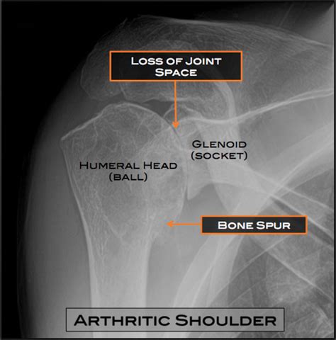 Shoulder Arthritis Austin, TX | Shoulder Surgery Austin, TX | Osteoarthritis Round Rock