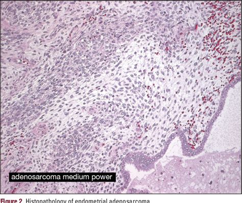 Figure 2 From UTERINE SARCOMA A RARE CAUSE OF UTERINE INVERSION