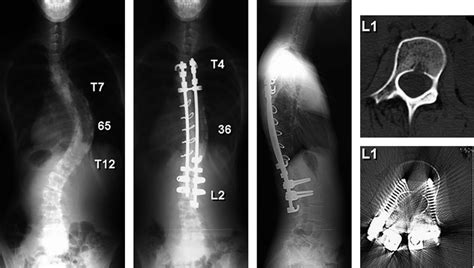 Accurate Pedicle Screw Insertion And Surgical Correction Of Scoliosis