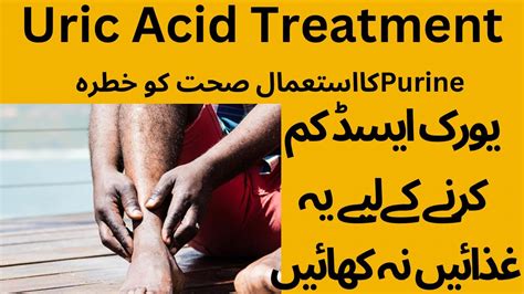 Uric Acid Ka Ilaj High Uric Acid Treatment Urdu Hindi Uric Acid Mai Kya Ni Khana Chahye Youtube