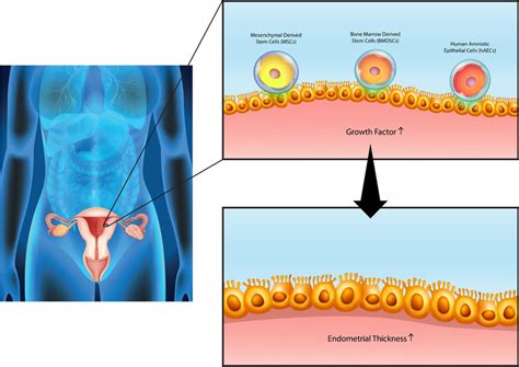 Schematic Of Thickening Of The Endometrium By Stem Cells With The