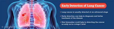 Early Detection Of Lung Cancer Possible With Newly Identified Biomarker