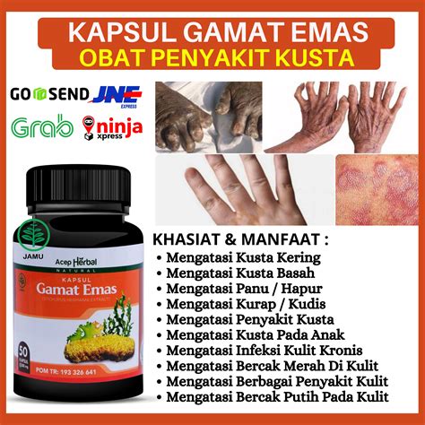 KAPSUL GAMAT EMAS ASLI Obat Untuk Penyakit Kusta Alami Kusta Kering