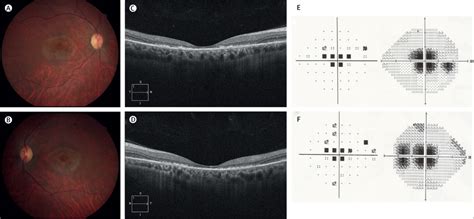 Hydroxychloroquine Induced Bull S Eye Maculopathy The Lancet Rheumatology