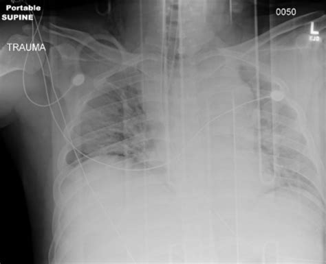 Widened Mediastinum Wikem