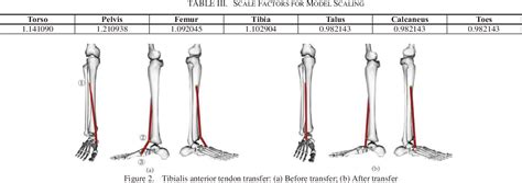 Figure 1 From Simulation Of Tibialis Anterior Muscle Transfer For Congenital Clubfoot Based On