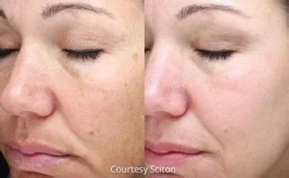 HALO Laser In Scottsdale Rejuvent Medical Spa Scottsdale