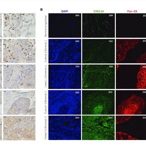 Cxcl Expression In Lung Cancer Tissues A Representative Images