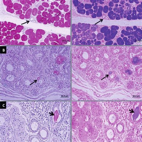 Microscopic Features Of Chronic Sclerosing Sialadenitis Küttner Tumor