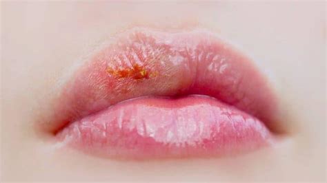 Cómo Saber Si Tengo Herpes Labial MiBBmemima