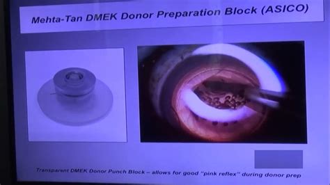 New Approaches To Descemet Membrane Endothelial Keratoplasty Dmek