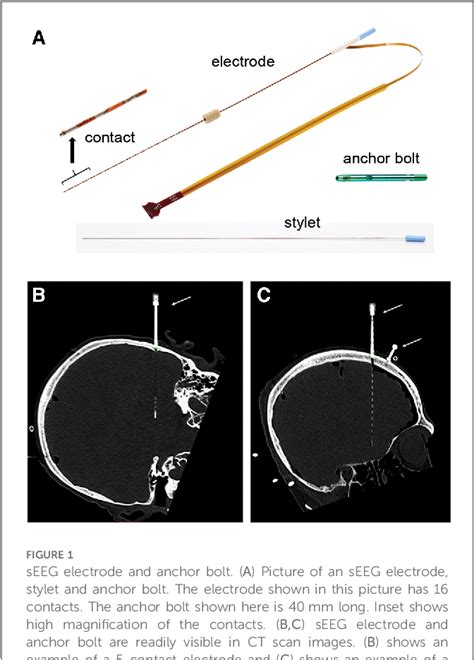 Figure 1 From Implantation Accuracy Of Novel Polyimide Stereotactic