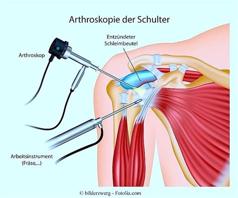 Läsion der Supraspinatussehne der Schulter Symptome Reabilitation und