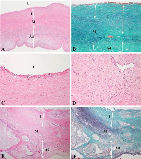 M1 Macrophage Is The Predominant Phenotype In Coronary Artery Lesions