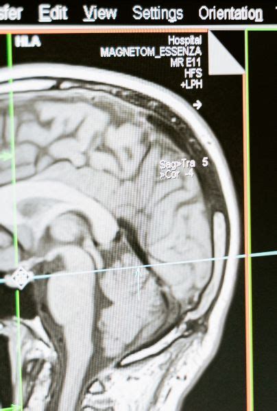 Señales De Aviso De Un Ataque Cerebral ¿cuáles Son Y Cómo Ayudar A