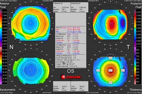 Corneal Topography And Tomography 9 1 Westmead Eye Manual