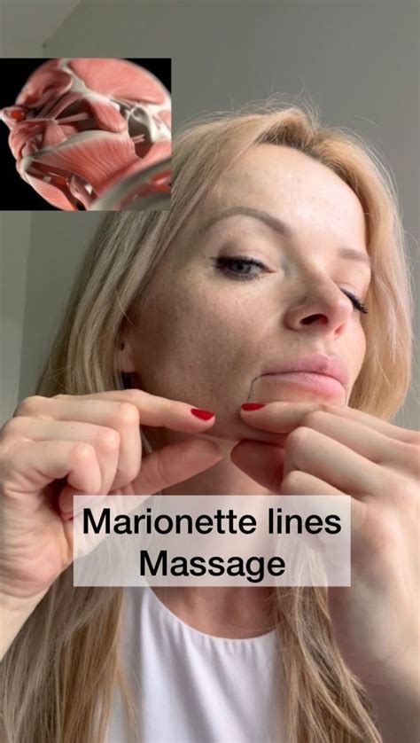 How To Reduce Marionette Lines And Achieve A Youthful Smile