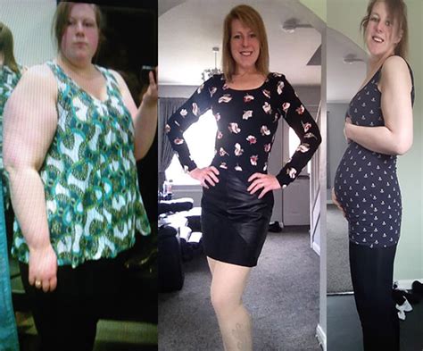 Weight Loss Surgery Before And After Photos Nordbariatric Clinic