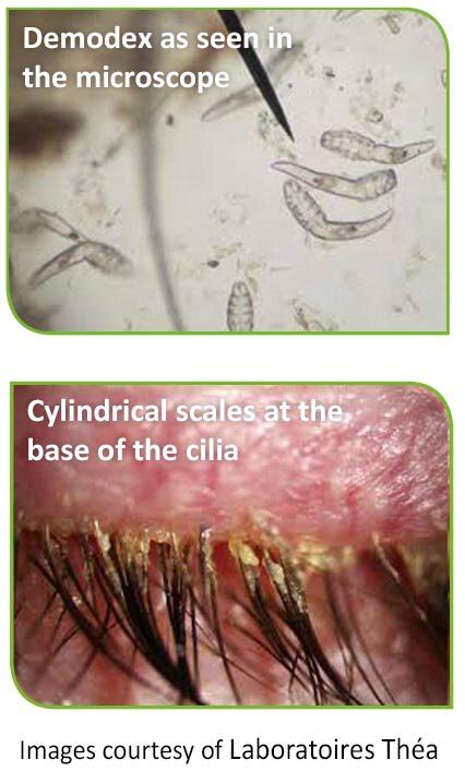 Lid Inflammation Blepharitis Demodex Ocular Surface Center Berlin