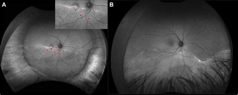 Retinal Displacement After Scleral Buckle Versus Combined Buckle And