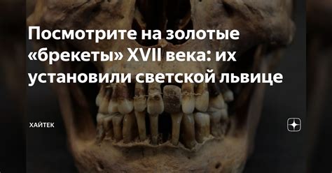 Посмотрите на золотые «брекеты» XVII века: их установили светской ...