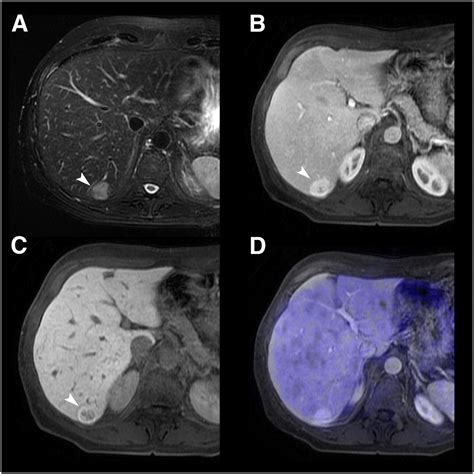 Value Of Retrospective Fusion Of Pet And Mr Images In Detection Of