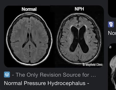 Nph With Shunt Installed Rhydrocephalus