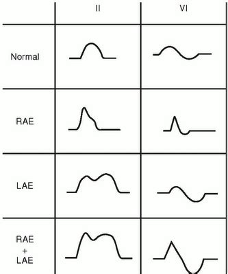 P wave morphologies | Ekg, P wave, Medical facts