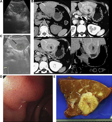 A Rare Cause Of A Liver Tumor Nodule Gastroenterology