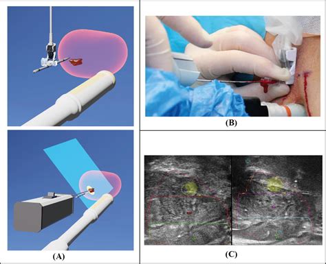 Vector Prostate Biopsy A Novel Magnetic Resonance Imagingultrasound Image Fusion Transperineal