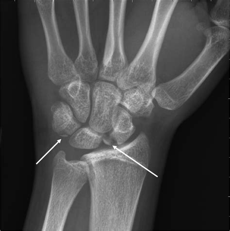 Triquetral Fracture