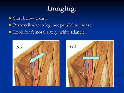 Ppt Femoral Nerve Block Powerpoint Presentation Free Download Id