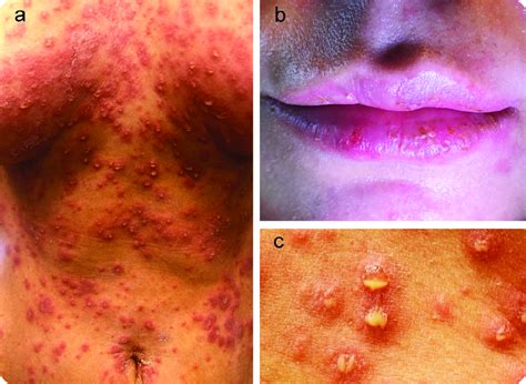 A Multiple Scaly Plaques In Annular Configurations And Sterile