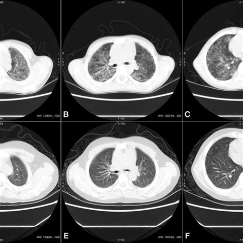 Gottron’s sign, radiological findings and pathological biopsy of... | Download Scientific Diagram