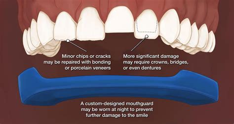 Bruxism Treatment - Dr Jamilian