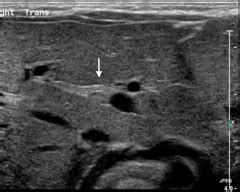 Liver Atlas Case Biliary Atresia