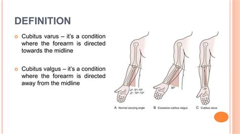 Cubitus varus and valgus