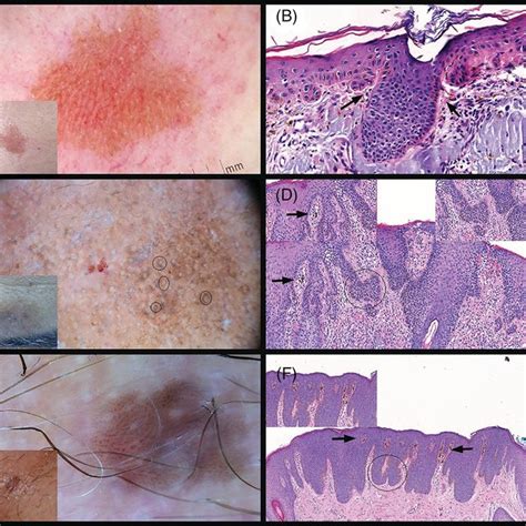 Dermatoscopic Findings And Dermatopathological Correlates In Clinical