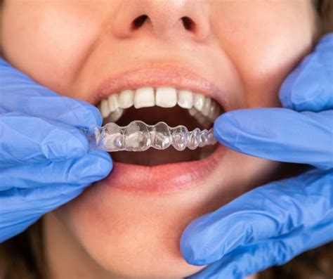 Invisalign Might Be Your Solution Learn Invisalign Cost