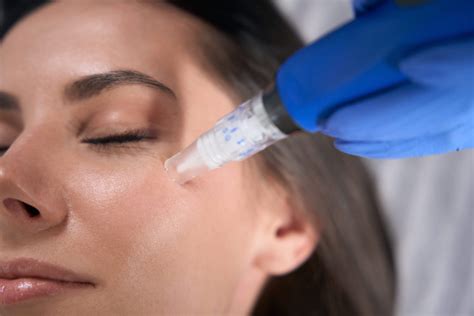 The Art Of Microneedling Unlocking Radiant Skin