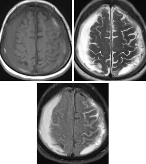 Subdural Hematoma Mri