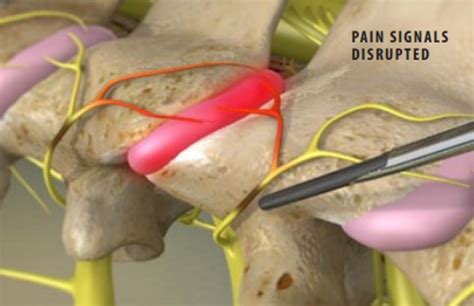 Cervical Facet Radiofrequency Neurotomy Neck Pain Treatment