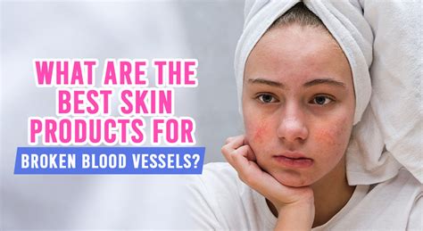 What Are the Best Skin Products For Broken Blood Vessels?