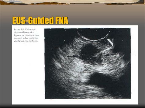 Ppt Fna Of The Pancreas Powerpoint Presentation Free Download Id